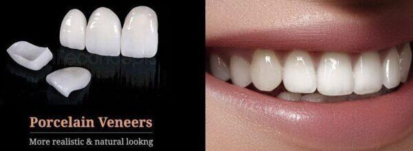 Tanden Tips - Esthetische Facings