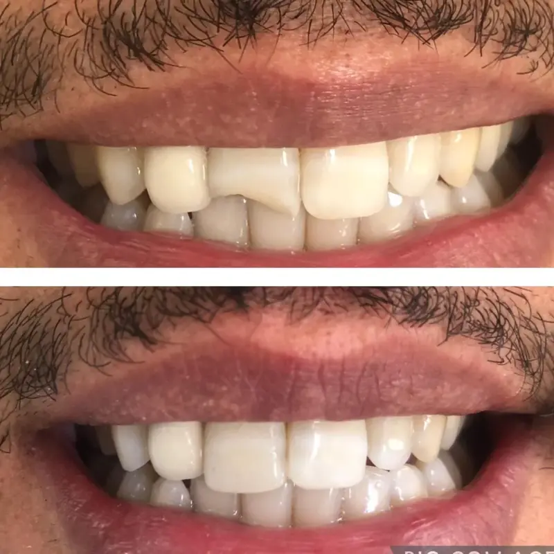 Tanden Tips - Composiet Bonding