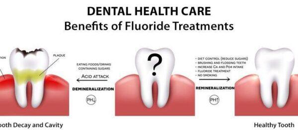 Tanden Tips - Fluoride Behandeling