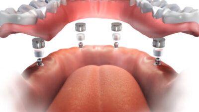 Tanden Tips - Permanente Kunstgebit