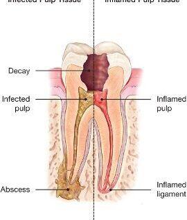 Tanden Tips - Endodontie Procedure