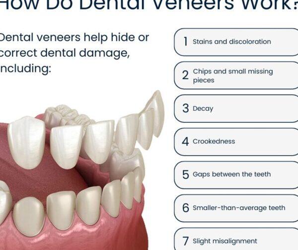 Tanden Tips - Facings