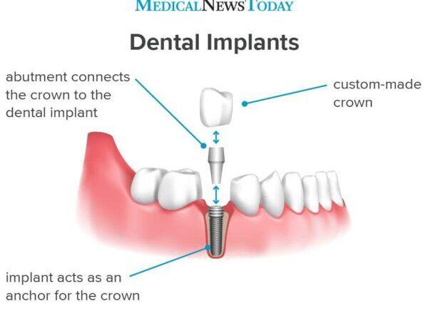 Tanden Tips - Implantaten