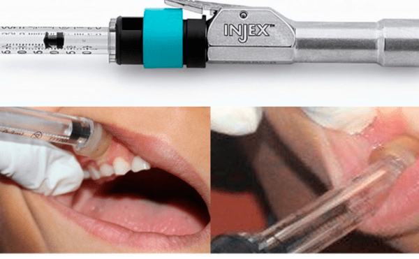 Tanden Tips - Lokale Anesthesie Tandarts
