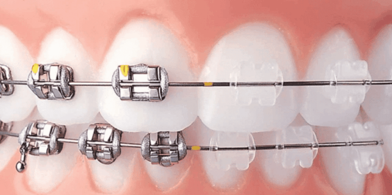 Tanden Tips - Permanente Beugel