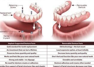 Tanden Tips - Permanente Kunstgebit