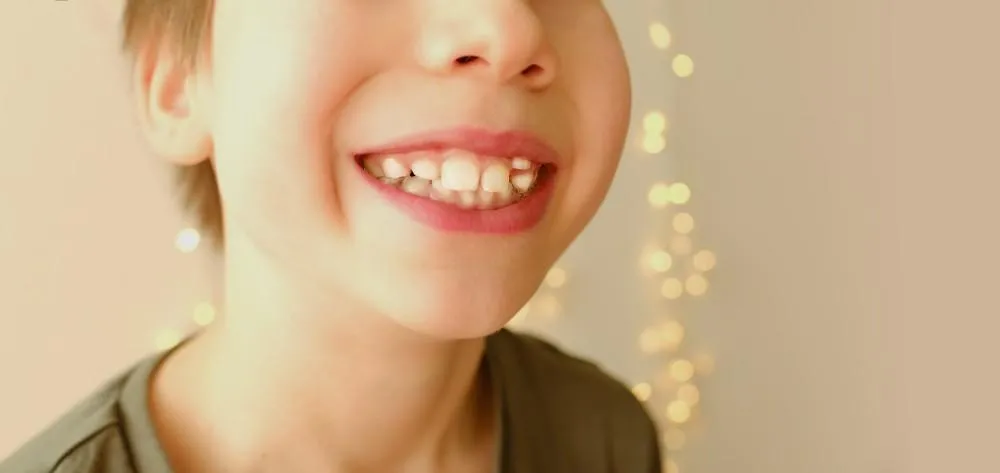 Vroege signalen dat je kind orthodontie nodig heeft: Let hierop! Hoe de ontwikkeling van het gebit van je kind te volgen