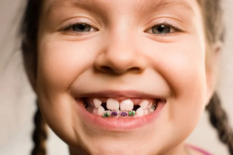 Vroege signalen dat je kind orthodontie nodig heeft: Let hierop! Veelvoorkomende symptomen van een orthodontische behoefte