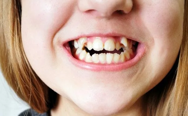 Vroege signalen dat je kind orthodontie nodig heeft: Let hierop! Wanneer is het tijd om een orthodontist te raadplegen?