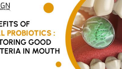 Tanden Tips - Acute Kiespijn