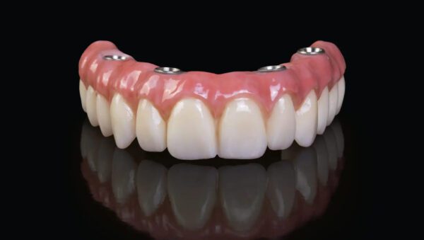 Tanden Tips - Kosten Kunstgebit