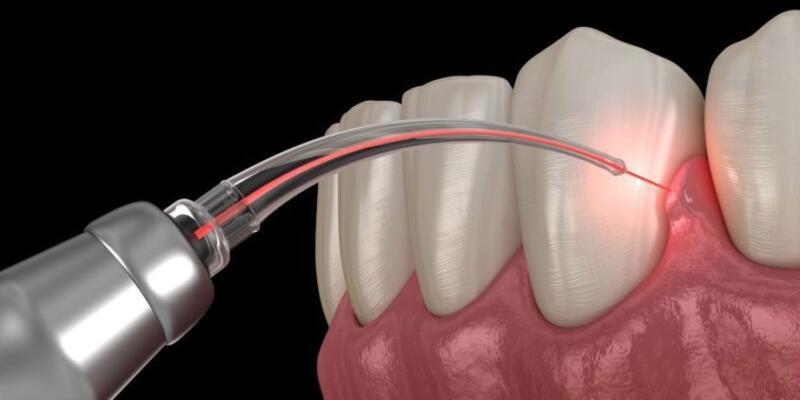 Tanden Tips - Laserbehandeling Parodontitis