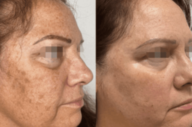 Tanden Tips - Laserbehandeling Parodontitis
