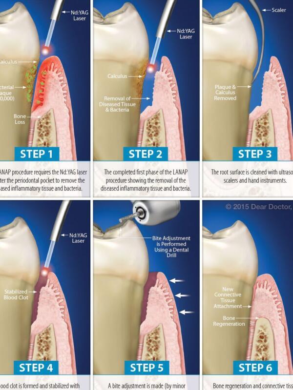 Tanden Tips - Laserbehandeling Parodontitis