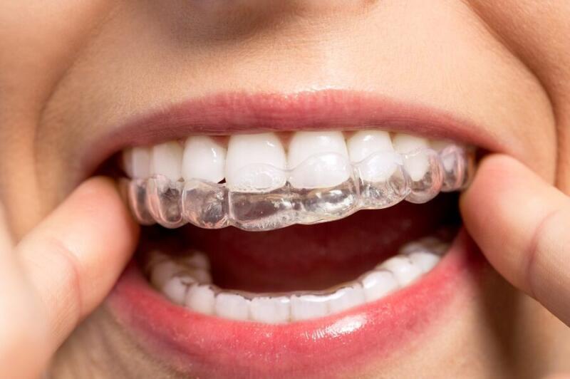 Tanden Tips - Invisalign