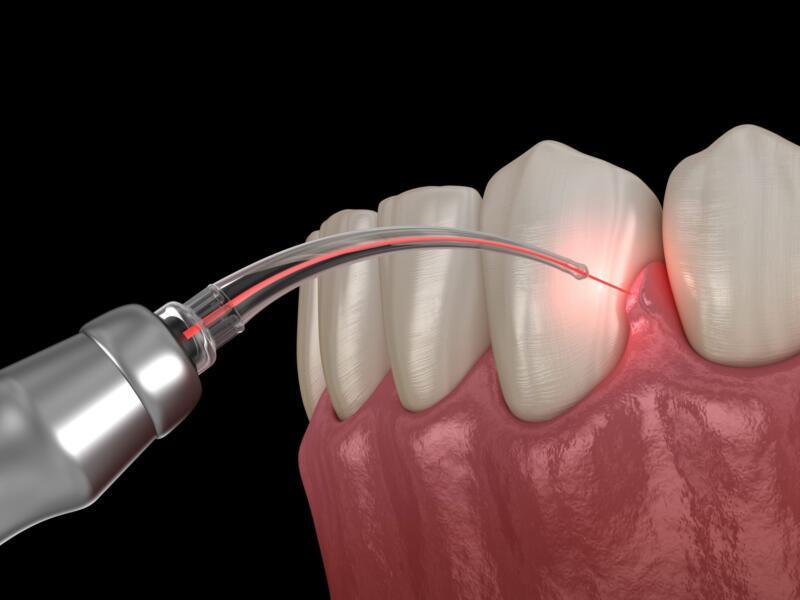 Tanden Tips - Laserbehandeling Parodontitis