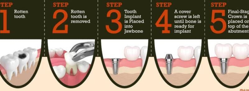 Tanden Tips - Gebitsprothese Laten Maken
