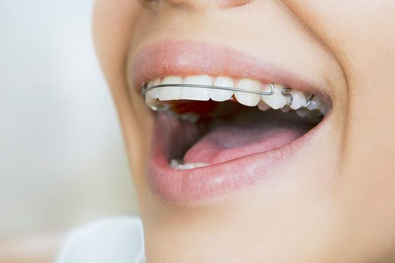 Tanden Tips - Retainer