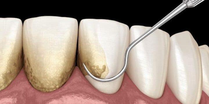 TANDSTEEN En ORTHODONTIE Wat Je MOET WETEN tandsteen-en-orthodontie-wat-je-moet-weten