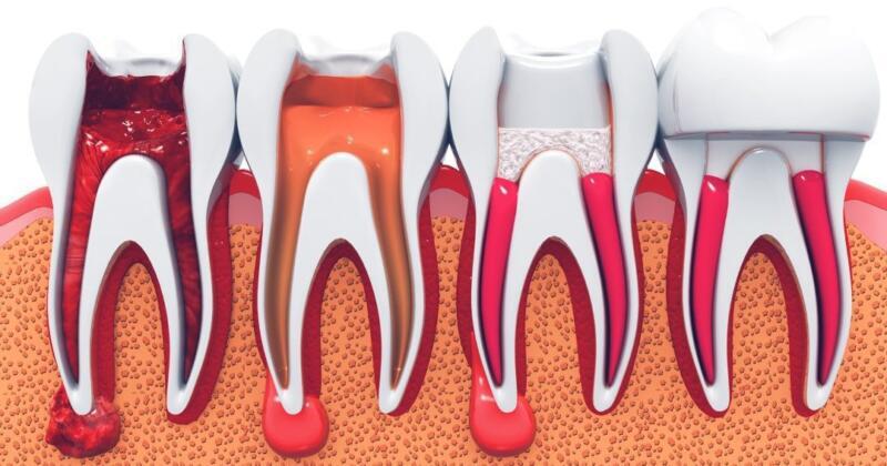 Tanden Tips - Endodontie Procedure