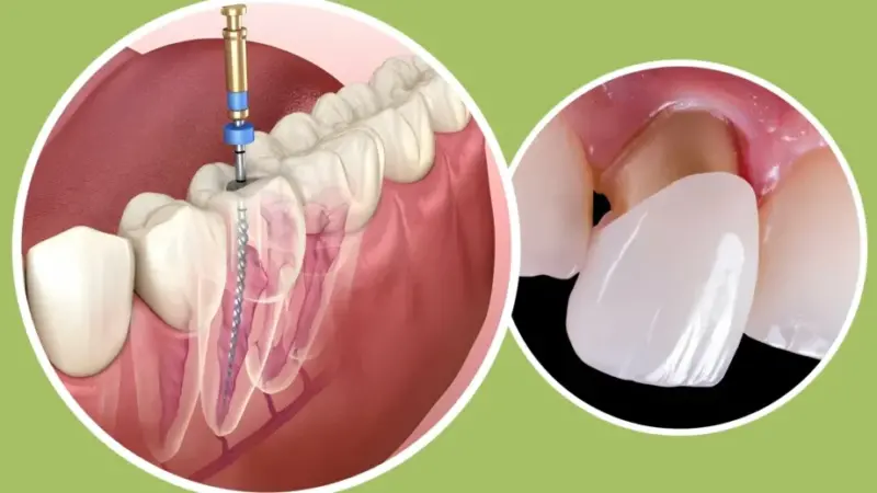 Tanden Tips - Endodontie Procedure
