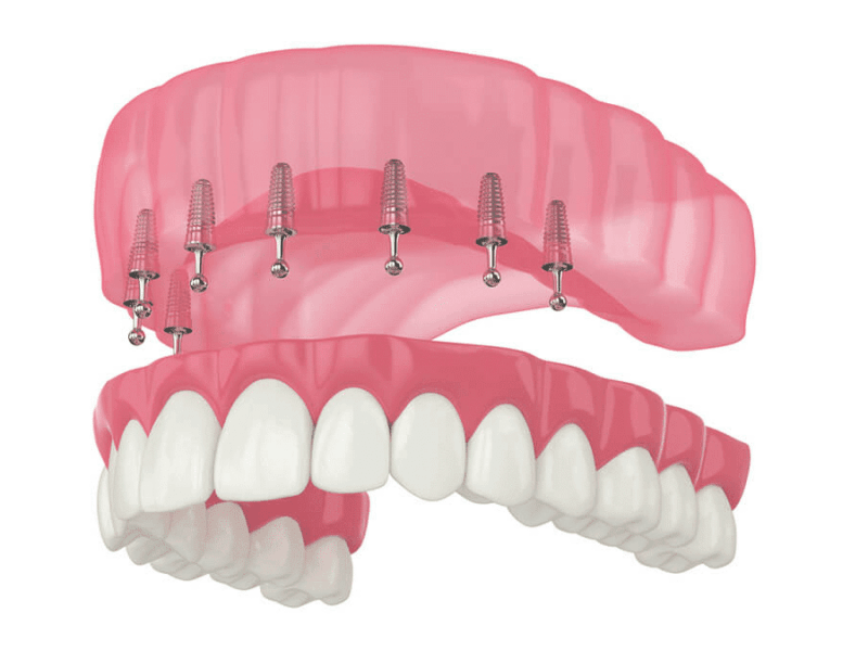 Tanden Tips - Gebitsprothese Laten Maken