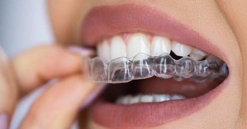 Tanden Tips - Invisalign