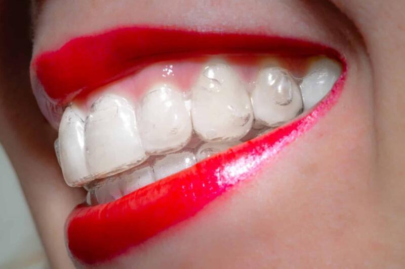 Tanden Tips - Invisalign