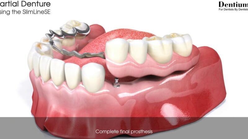 Tanden Tips - Gebitsprothese Laten Maken
