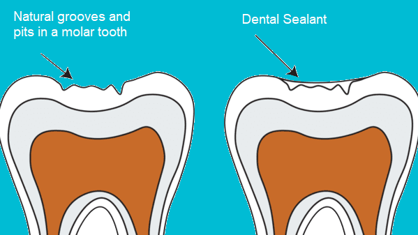Tanden Tips - Sealants bij Kinderen