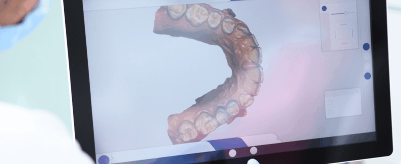 Tanden Tips - Invisalign