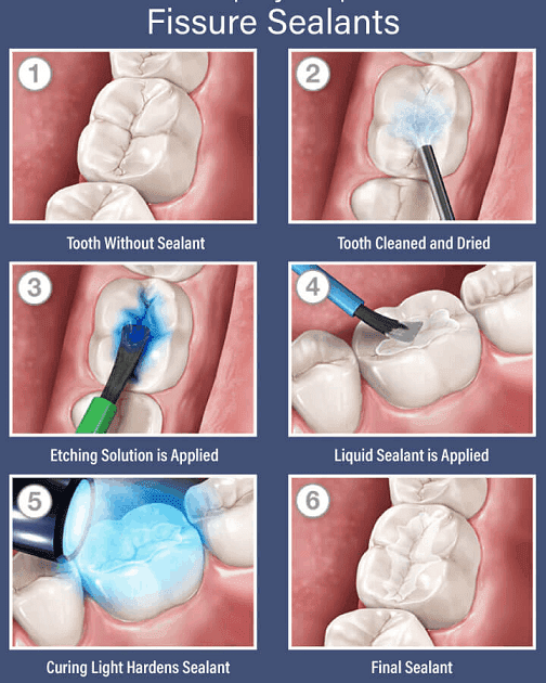 Tanden Tips - Sealants bij Kinderen