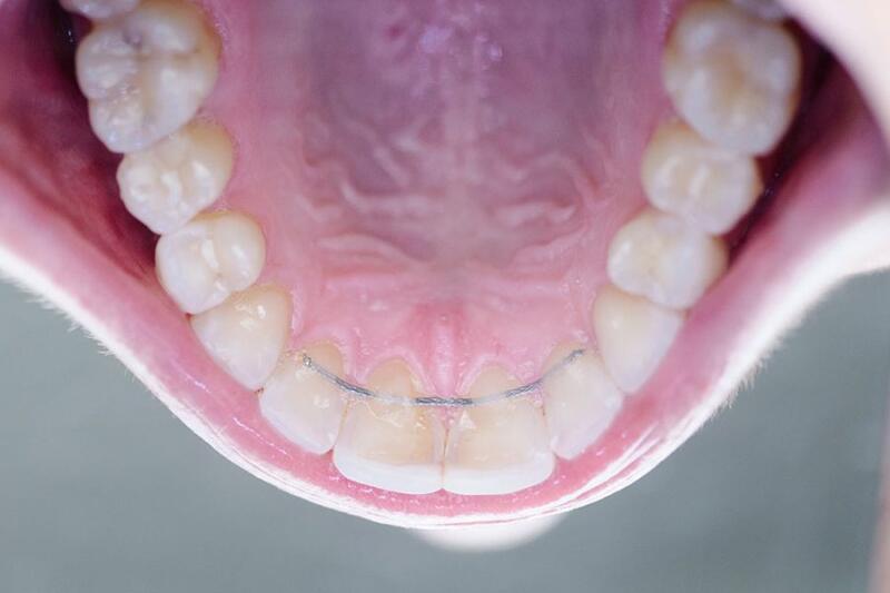 Tanden Tips - Retainer