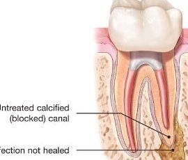 Tanden Tips - Endodontie Procedure