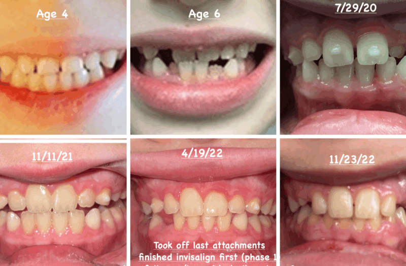Tanden Tips - Invisalign