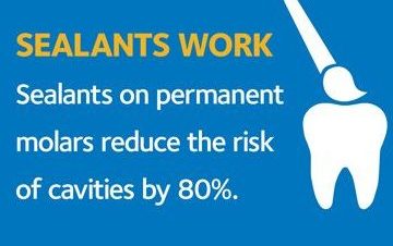Tanden Tips - Sealants bij Kinderen