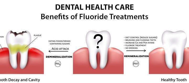 Tanden Tips - Fluoride Behandeling