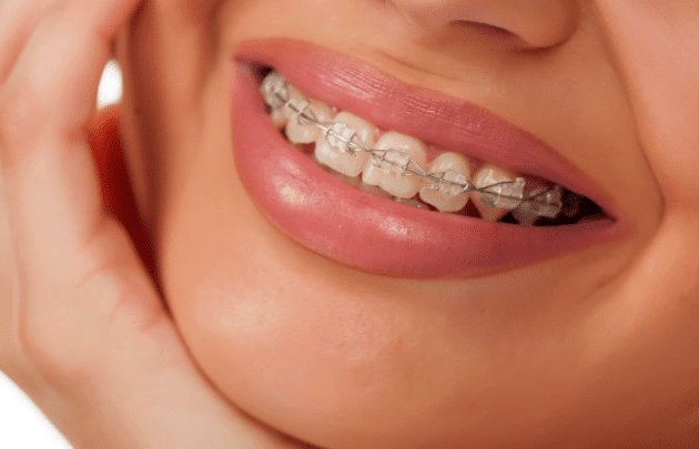 Tanden Tips - Metalen Beugels
