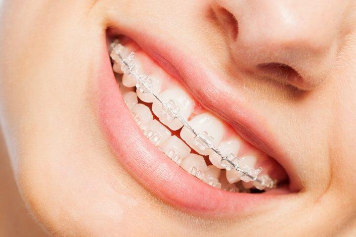 Tanden Tips - Transparante Beugels