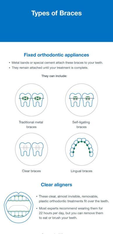 Tanden Tips - Retainer