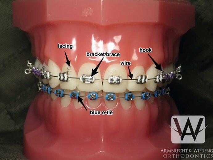 Tanden Tips - Permanente Beugel