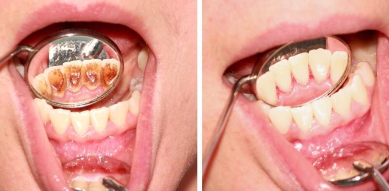 Tanden Tips - Gebitsreiniging