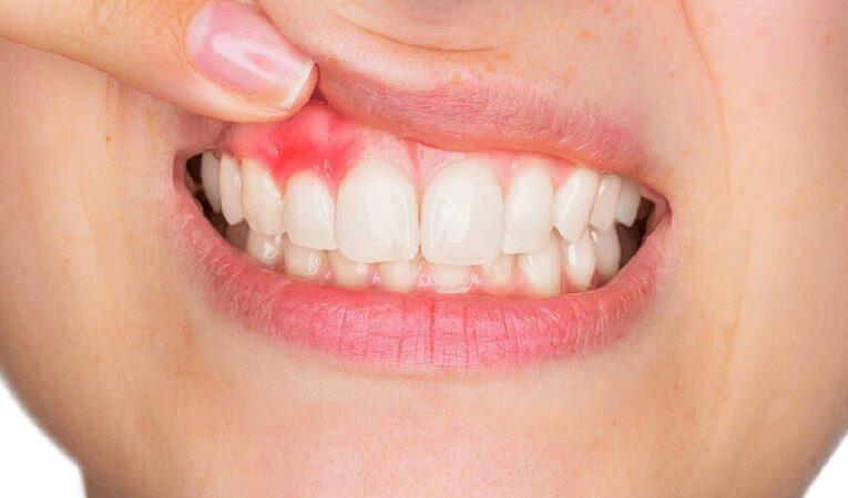 Tanden Tips - Retainer