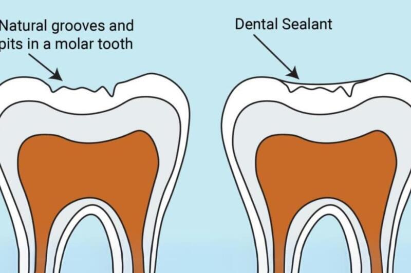 Tanden Tips - Sealants bij Kinderen