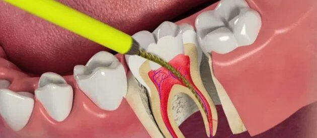 Tanden Tips - Endodontie Procedure