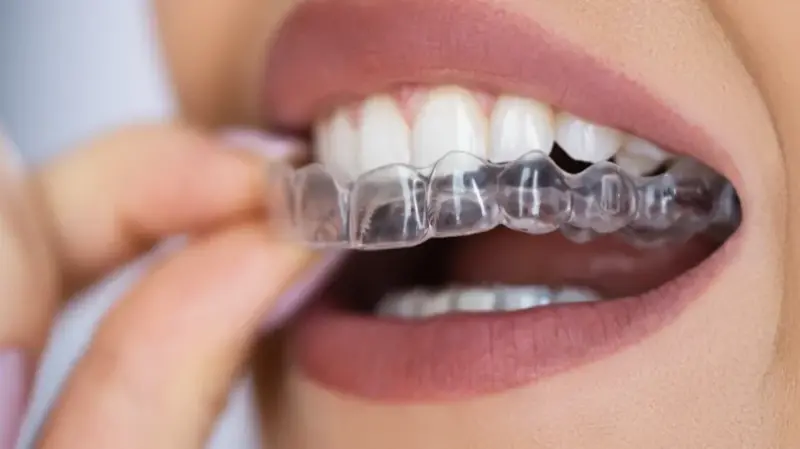 Tanden Tips - Invisalign