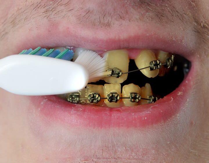 Tanden Tips - Retainer