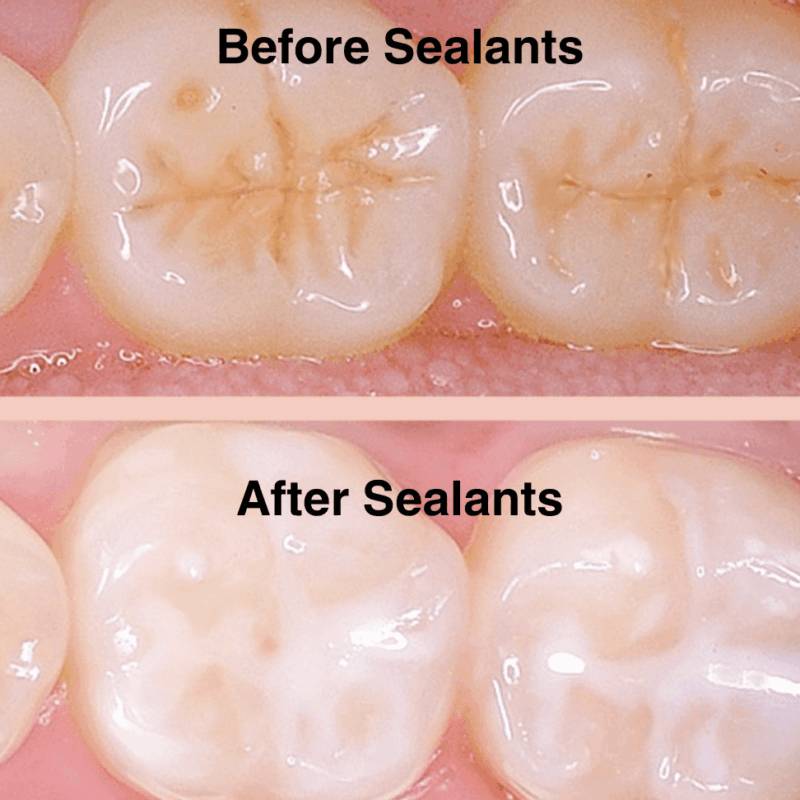Tanden Tips - Sealants bij Kinderen