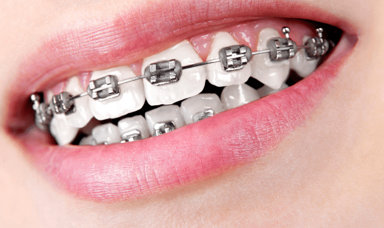 Tanden Tips - Metalen Beugels