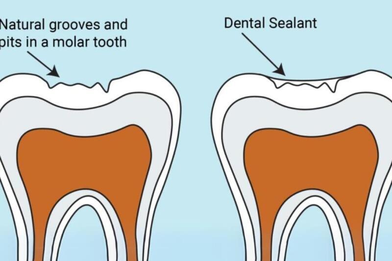 Tanden Tips - Sealants bij Kinderen